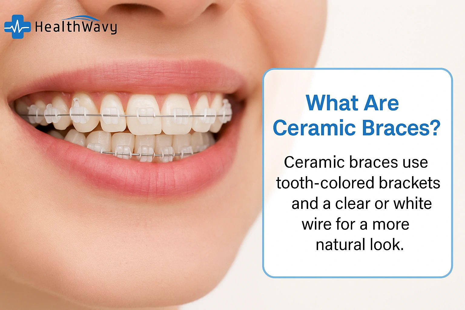 Ceramic Braces